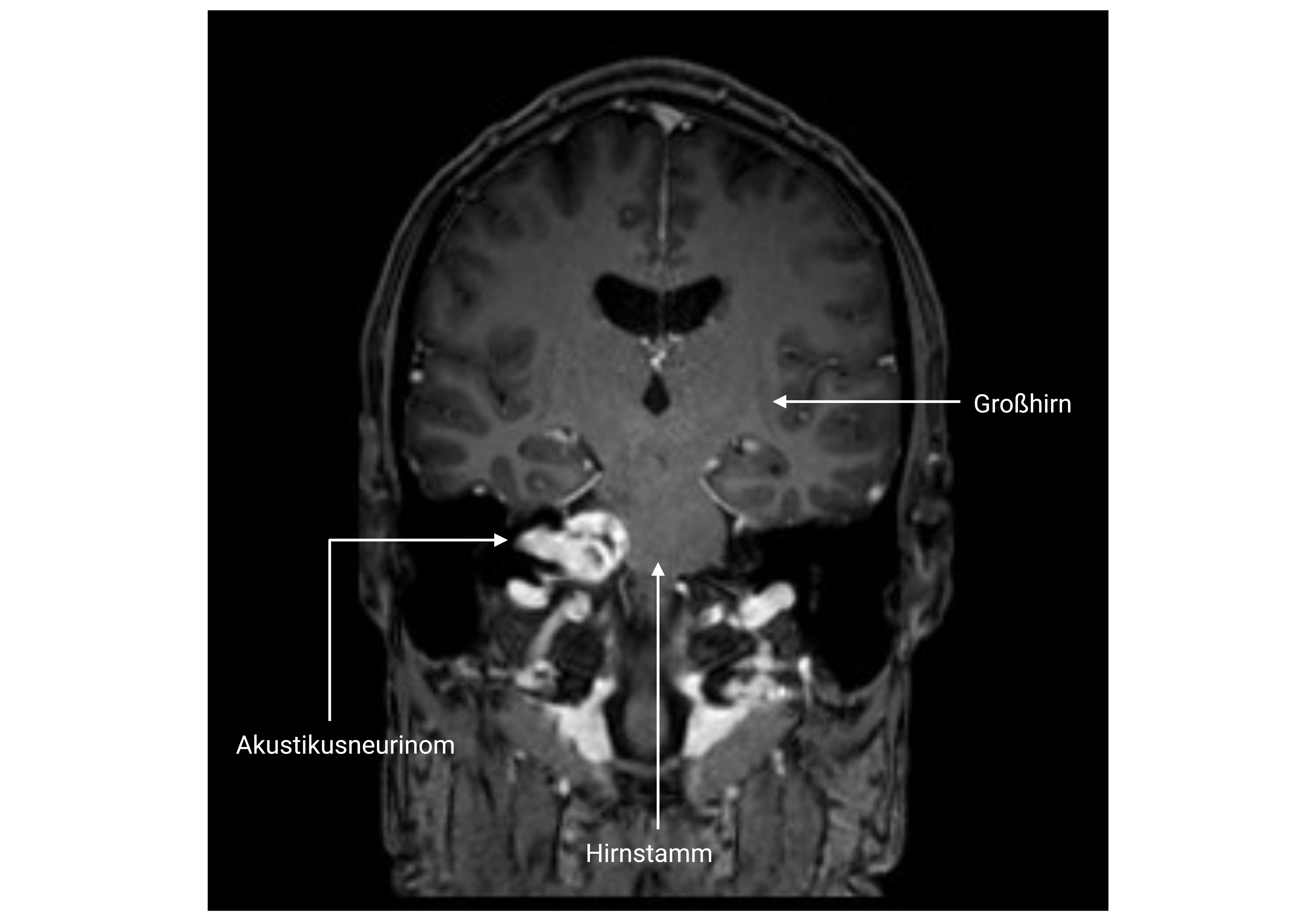Kranielle MRT-Bildgebung (T1-Wichtung mit Kontrastmittel, coronar)