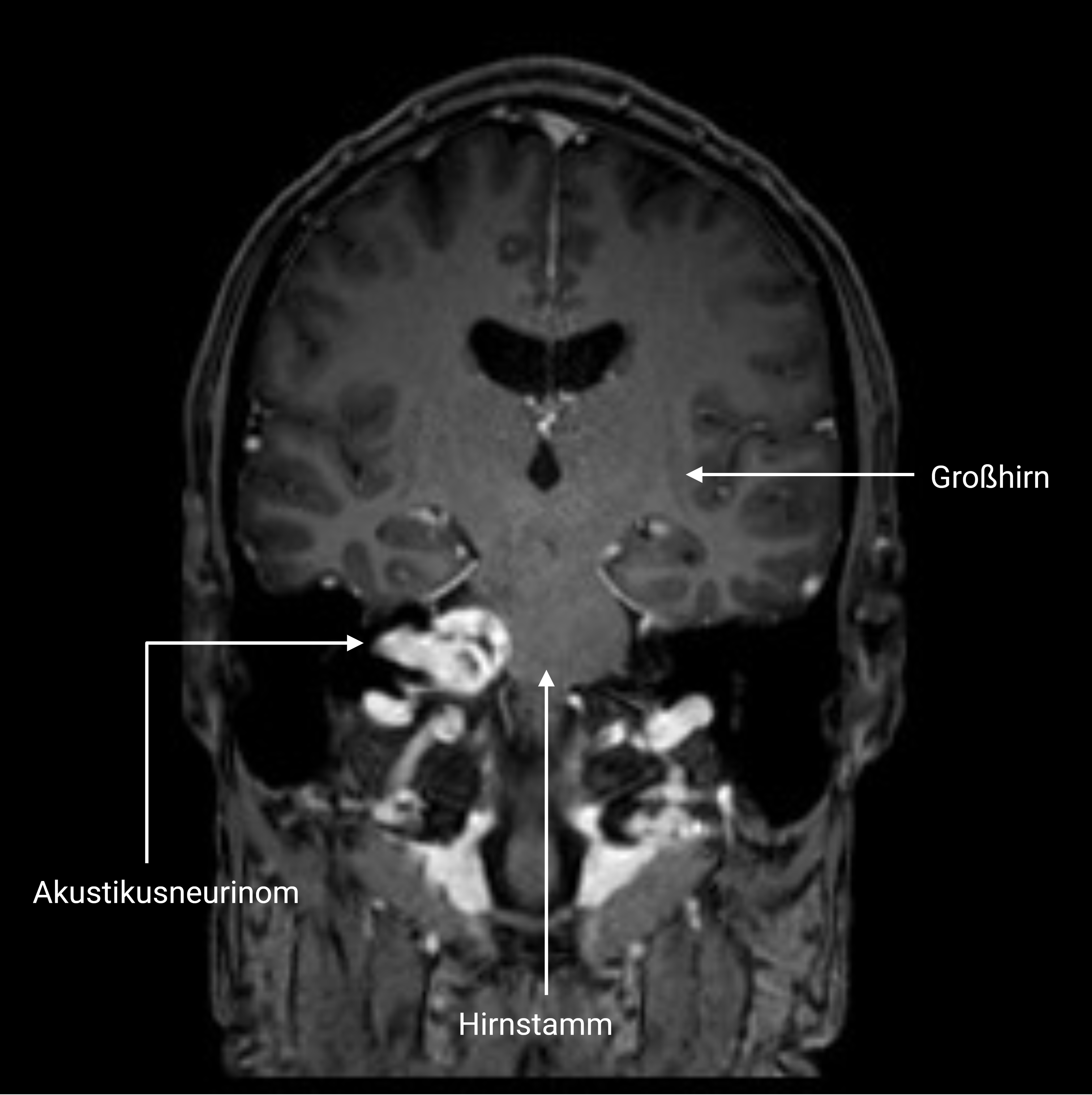 Kranielle MRT-Bildgebung (T1-Wichtung mit Kontrastmittel, coronar)